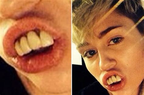 Miley Cyrus Sports Giant Veneers With New Horse Teeth