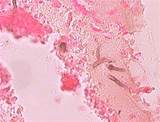 Fungus In Sinus Mayo Clinic Pictures