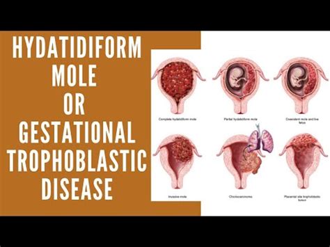 Hydatidiform Mole Vesicular Mole Molar Pregnancy Gestational