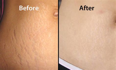 Stretch Marks Before And After Weight Loss Men Weightlosslook