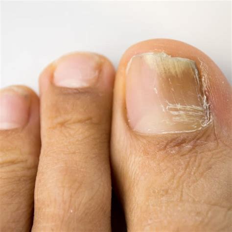 Omaha Toenail Fungus Treatment Nail Disease And Abnormalities