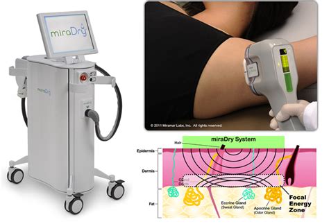 Miradry For Excessive Underarm Sweating Advanced Dermatology And Skin
