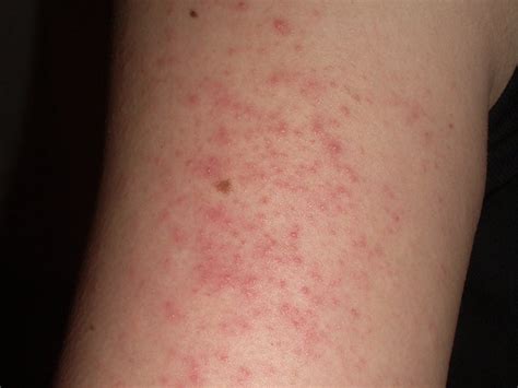 Itchy Skin Rash Red Bumps On Arms Sexiz Pix