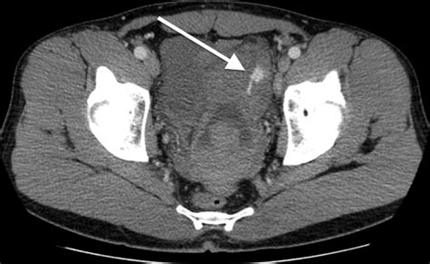 Axial Ct Scan Demonstrating Active Extravasation Within The Pelvis