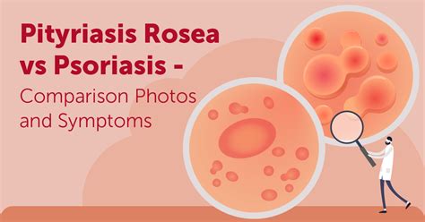 Related Conditions Mypsoriasisteam