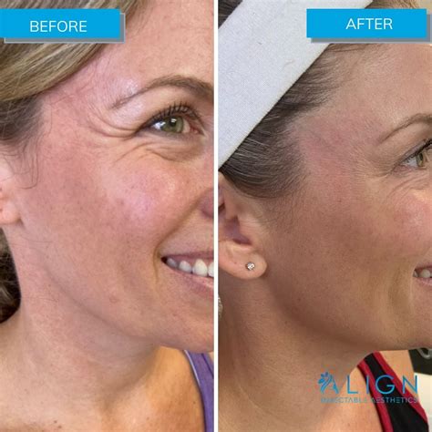 before and after botox® for crow s feet align injectable aesthetics