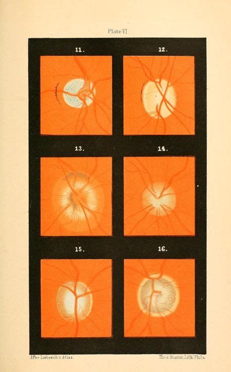 Plate Vi A Treatise On Diseases Of The Eye 1883 Nemfrog Diseases