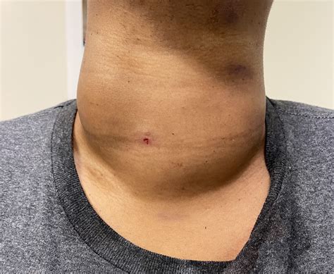 Rfa Ablation Of Large Bilateral Thyroid Nodules Goiter