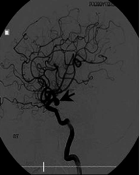 4 Vessel Angiography Shows Both Posterior Communicating Artery