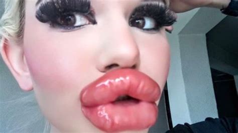 Woman Has Lip Filler Injections To Have Worlds Biggest Lips Photo News Com Au