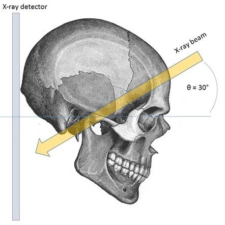The name ap is because the x ray beam travels anterior to posterior through the skull. Towne view (skull AP axial view) | Image | Radiopaedia.org