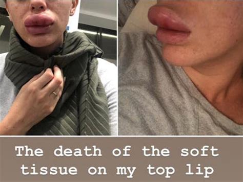 400 Botox Party Leaves Woman In Agony With Swollen Lips News Com Au