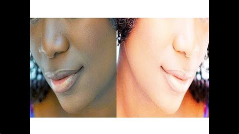 How To Remove Lips Corner Darknessrid Of Dark Black Skin Around Mouth