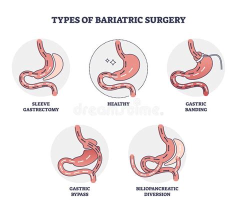 Types Of Bariatric Surgery It Is Process For The Digestive System In