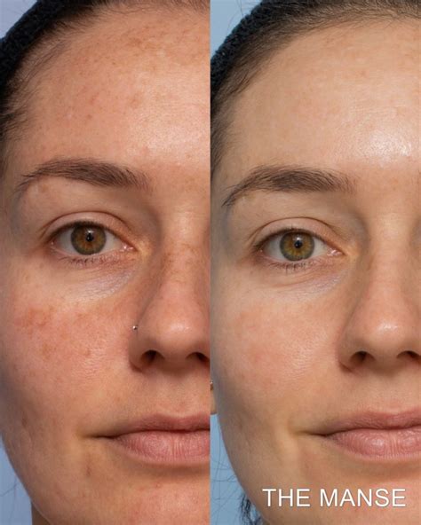 Pigmentation Treatment Best Clinic Sydney For Dermal Fillers