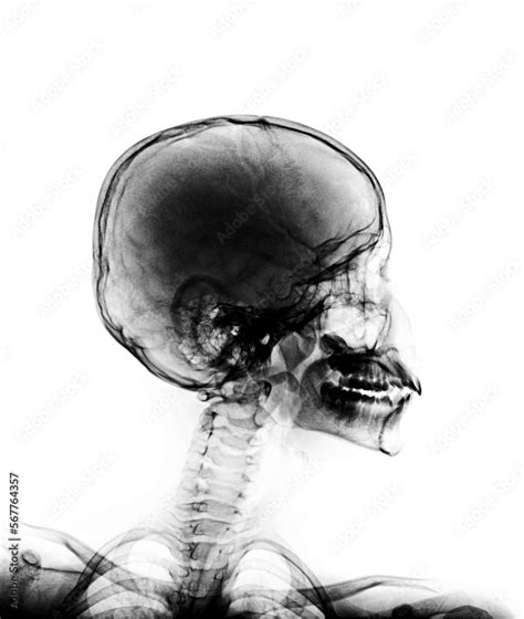 X Ray Normal Skull And Cervical Spine Lateral View Stock