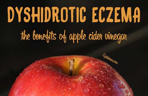 Apple Cider Vinegar For Dyshidrotic Eczemapompholyx The Best Home