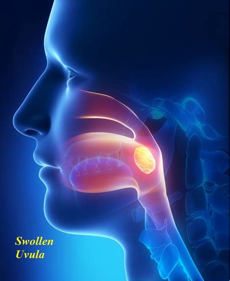 Swollen Uvula Causes Symptoms Pictures Treatment And Prevention