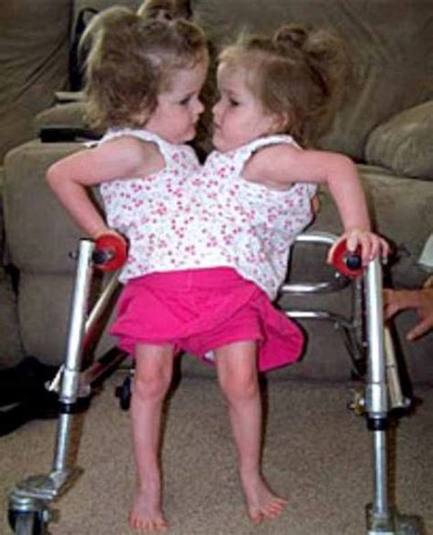 Conjoined Twins Who Have One Leg Each After Separation Surgery Now Feel The Same As Everybody