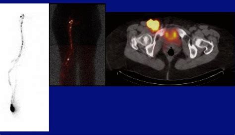 Lymphoscintigraphy With The Injection Site At The Lateral Right Ankle
