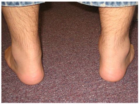 Posterior View Of Ankles Showing Swelling Of The Right Achilles Tendon