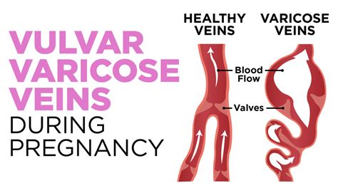 1 Vulvar Varicosities Guide What Are Pelvic Varicose Veins