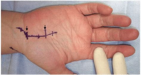 Surgical Options For Recurrent Carpal Tunnel Syndrome Musculoskeletal Key