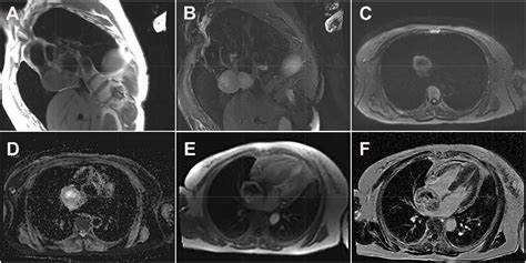 Frontiers Multimodality Imaging Evaluation Of Primary Right Atrial
