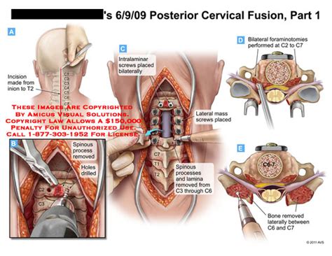 Posterior Cervical Fusion Part