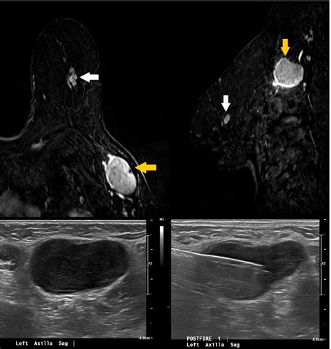 Axillary Adenopathy Detected On Breast Mri Following Covid 19