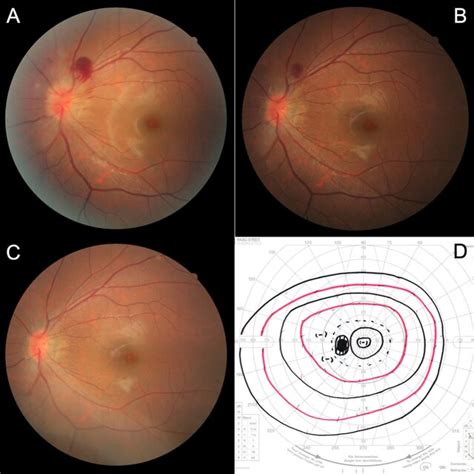Fundus Photographs Taken 1 A 2 B And 5 C Months Later Showing