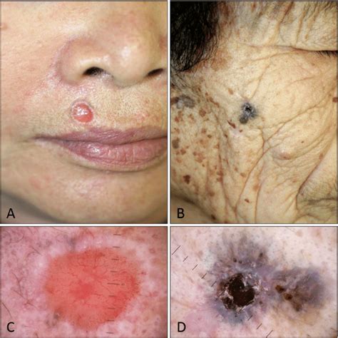 Skin Cancer Types Basal Cell Carcinoma Bcc Squamous Cell Images And