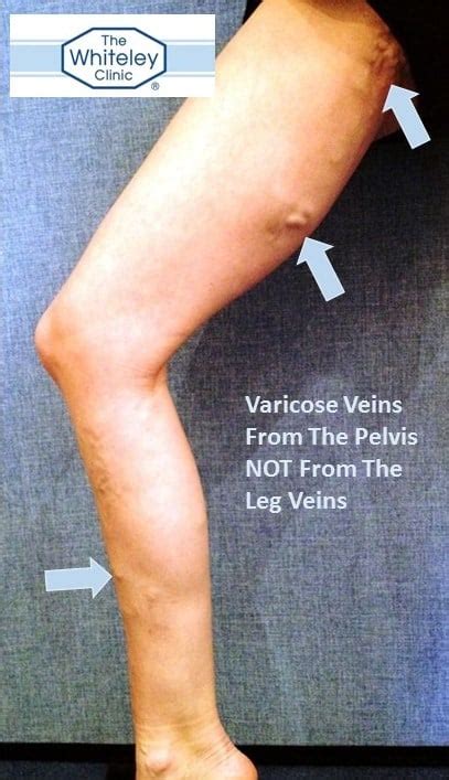 Varicose Veins From The Pelvis The Whiteley Clinic