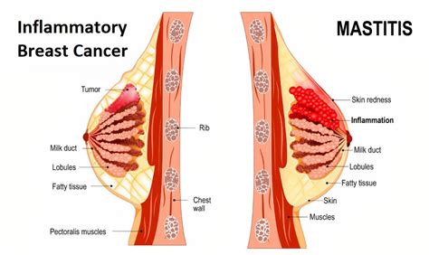 It's important to have anything unusual checked by your doctor. Inflammatory Breast Cancer | Symptoms, Stages, Diagnosis ...