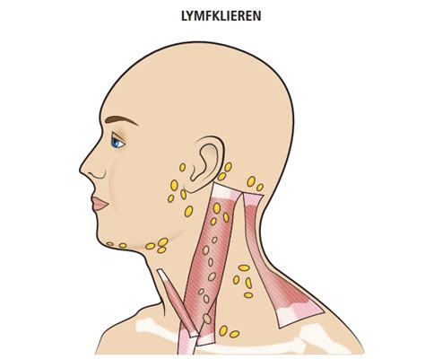 Symptomen Lymfeklier Hals Symptomen