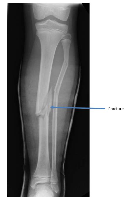 Tibia Fracture Types
