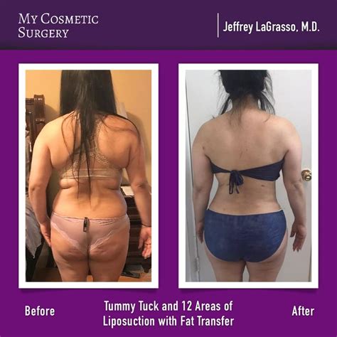 Before And After A Tummy Tuck And Brazilian Butt Lift By Jeffrey Lagrasso M D At My Cosmetic