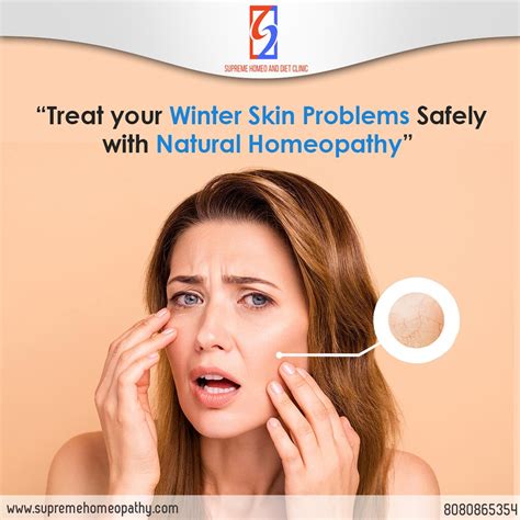 Treat Dry Skin Of Winter Safely With Homeopathy Dry And Cr Flickr