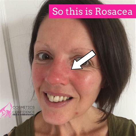 Cure For Rosacea My Own Experience And Tips Cosmetics For Confidence