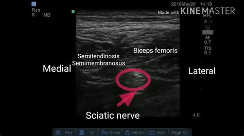 Ultrasound Guided Sciatic Nerve Block In The Midthigh Region Youtube