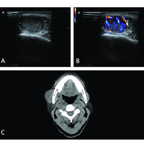 Imaging Manifestations Of Masseter Muscle Metastasis In Us And Ct Us