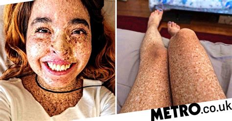 Woman S Rare Skin Condition Makes Her Allergic To Sunlight Metro News