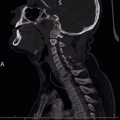 Ct Cervical Spine Without Contrast Showing Unstable C7 Burst Fracture
