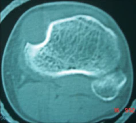 Ct Scan Axial View Showed A Well Circumscribed Mass On The Smooth