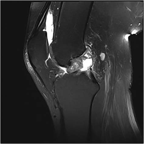 Sagittal T Mri Image Proton Density Fat Saturation Of Knee Showing Download Scientific