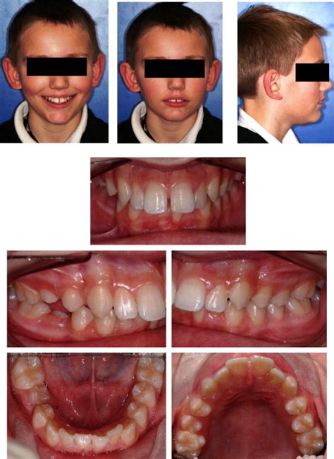 Pre Treatment Clinical Photographs Note That The Molar Relationship Is