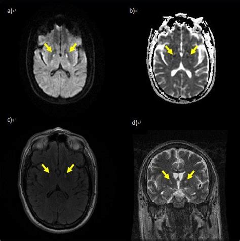 Ischemic Brain Injury Secondary To Severe Systemic Loxoscelism