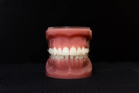 Premium Photo Orthodontic Jaw Model Demonstration Teeth With Ceramic