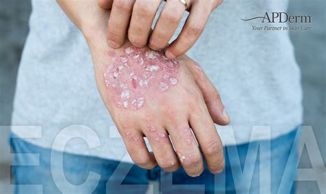 What Does Eczema Look Like Apderm