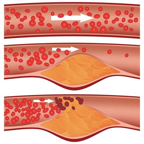 What Is Atherosclerosis Diagnosis Treatment And Prevention